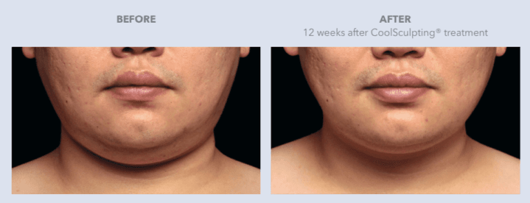 Before and After CoolSculpting Services | Lily Med Spa in Dallas, Texas