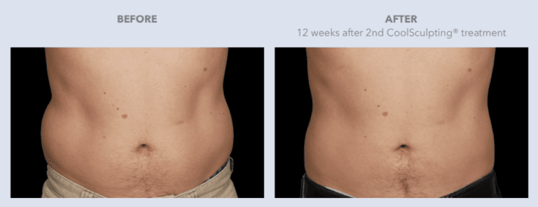 Before and After CoolSculpting Services | Lily Med Spa in Dallas, Texas