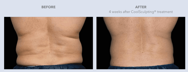 Before and After Images CoolSculpting® Services in Dallas, TX | Lily Medspa in Dallas TX