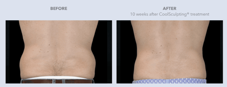 Before and After Images CoolSculpting® Services in Dallas, TX | Lily Medspa in Dallas TX