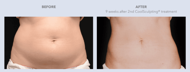 Before and After Images CoolSculpting® Services in Dallas, TX | Lily Medspa in Dallas TX