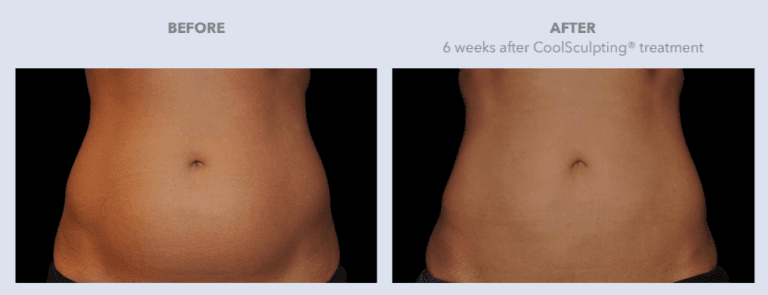 Before and After CoolSculpting® Services in Dallas, TX | Lily Medspa in Dallas TX