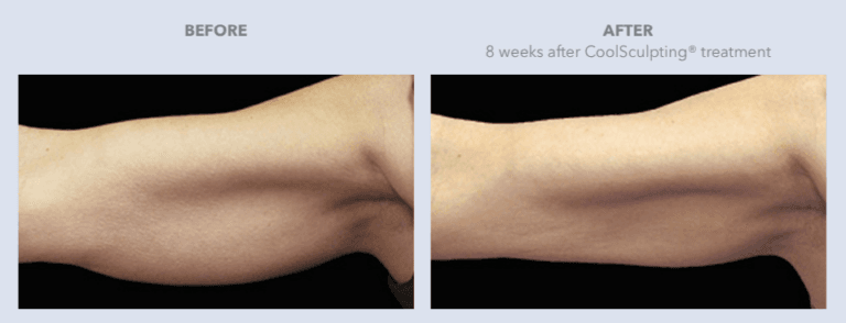 Before and After CoolSculpting® Services in Dallas, TX | Lily Medspa in Dallas TX