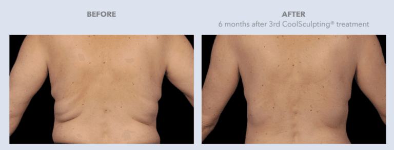 Before and After Images CoolSculpting® Services in Dallas, TX | Lily Medspa in Dallas TX