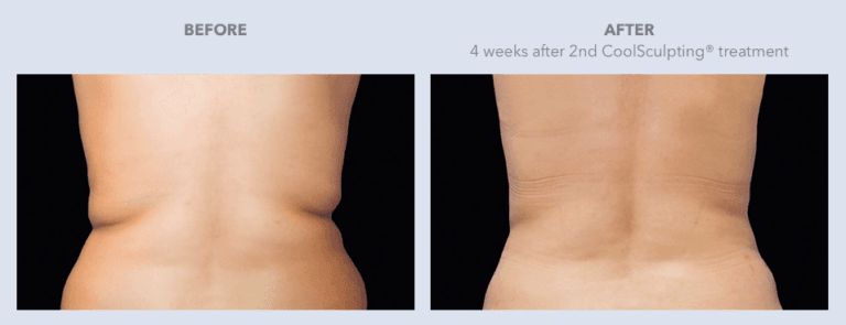 Before and After Images CoolSculpting® Services in Dallas, TX | Lily Medspa in Dallas TX