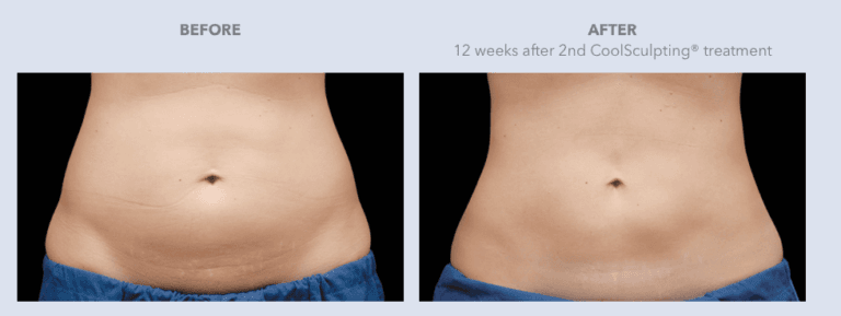 CoolSculpting® Services in Dallas, TX | Lily Medspa in Dallas TX