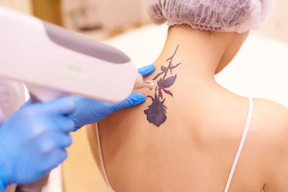 Laser Tattoo Removal by Lily Med Spa Corporation in Dallas , Texas