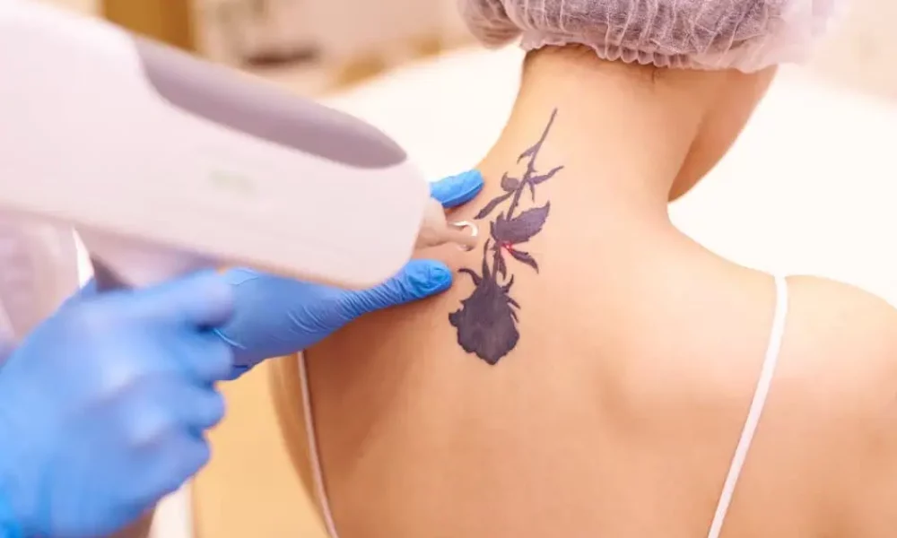 Laser Tattoo Removal by Lily Med Spa Corporation in Dallas , Texas