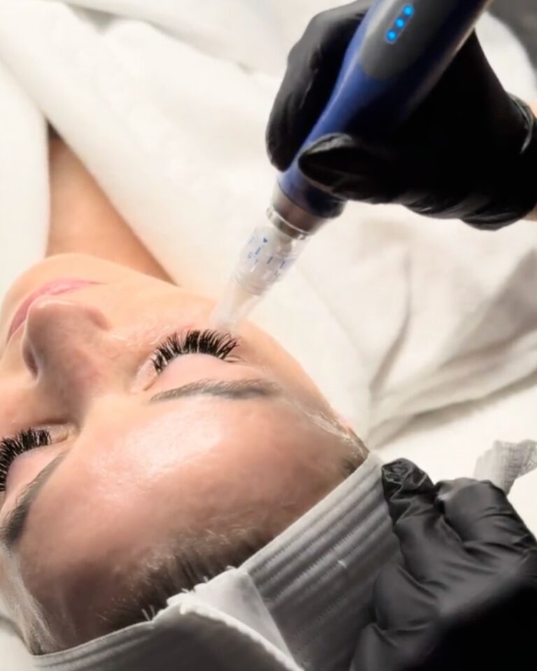 SkinPen® microneedling