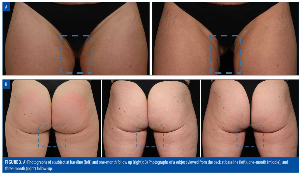emsculpt for legs